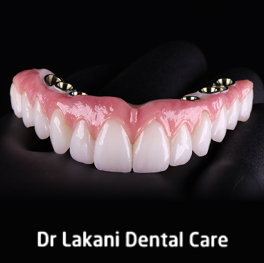 Hybrid Implant Bridge